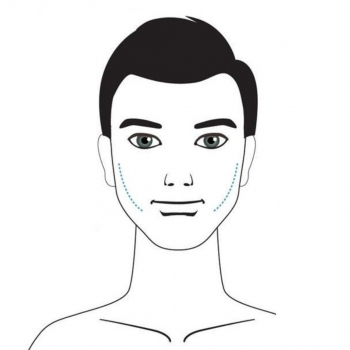 Hermes Clinics - Malarplasty 