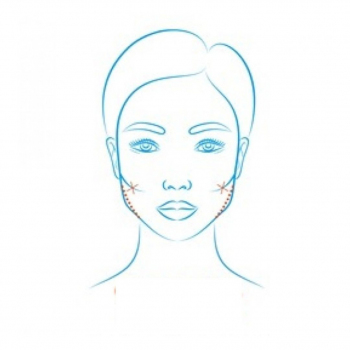 Metropolmed Clinic - Cheek Bone Reduction 