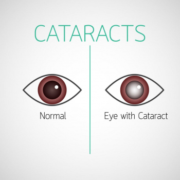 Cerrahi (Surgery Group) - Cataracts 