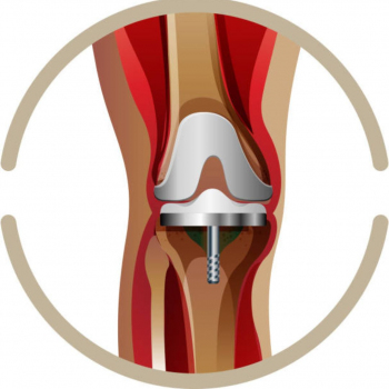 Cayra Clinic - Zamenjava kolena 