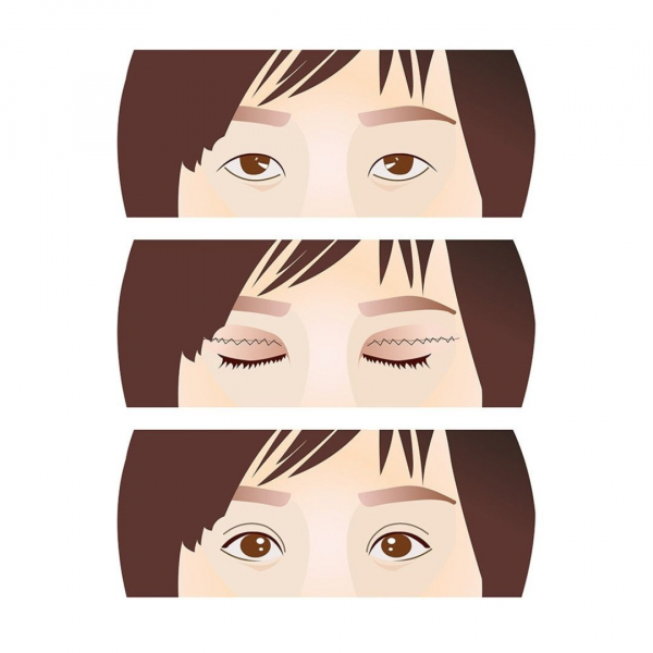 Masterpiece Hospital - Double eye lids 