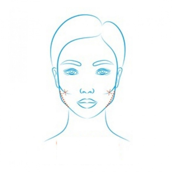 F Clinic - Cheek Bone Reduction 