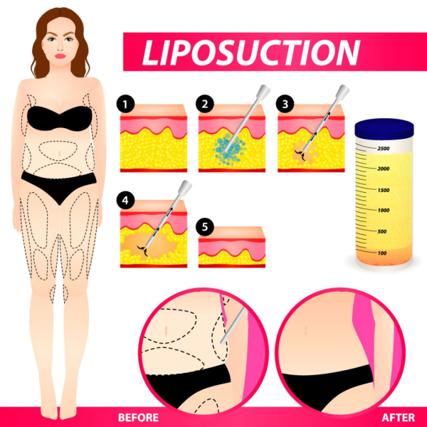 De-Klinika - Vaser Liposuction 
