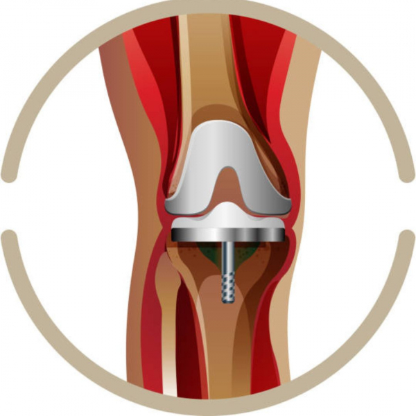 Estebox Istanbul - Knee Replacement 