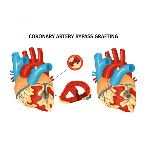 Medicana Atasehir Hospital - Coronary Artery Bypass 