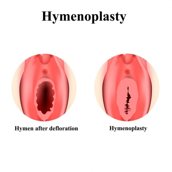 Alara Health Group - Hymenoplasty 