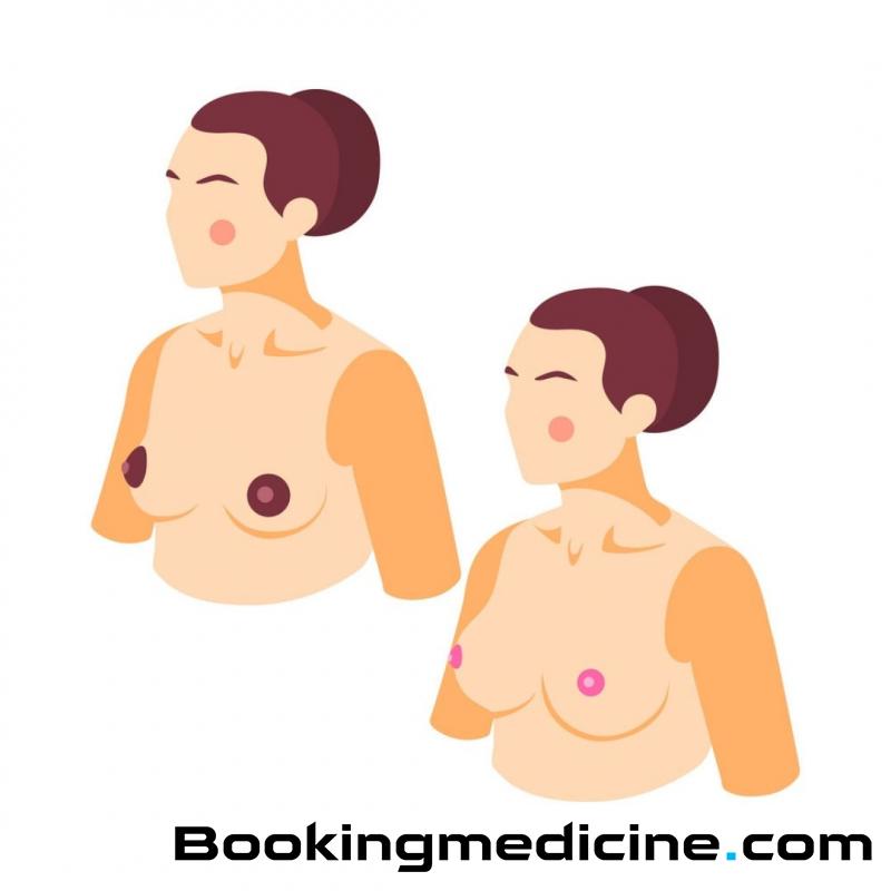 Dr. Karantonis Plastic Surgeon - Korekcija prsnih bradavic 