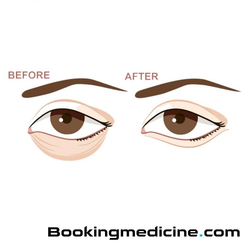 Absolute Beauty Clinic - Donja Blefaroplastika 