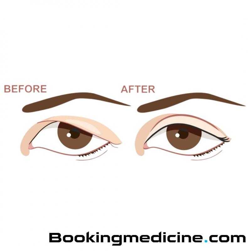 KCM Clinic - Gornja Blefaroplastika 