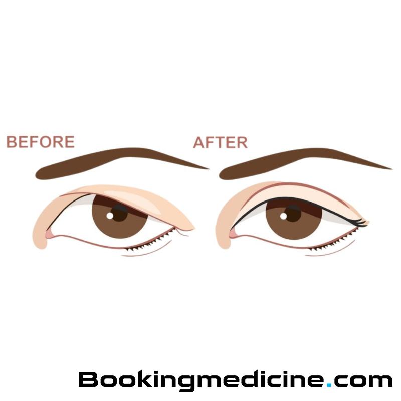 Orea - Upper Blepharoplasty 