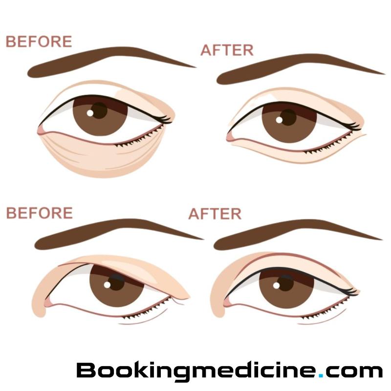 Antalya Health - Upper or Lower Blepharoplasty 