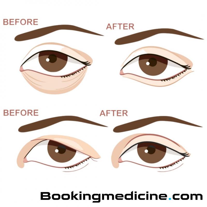 My Esthetics Turkey - Upper or Lower Blepharoplasty 