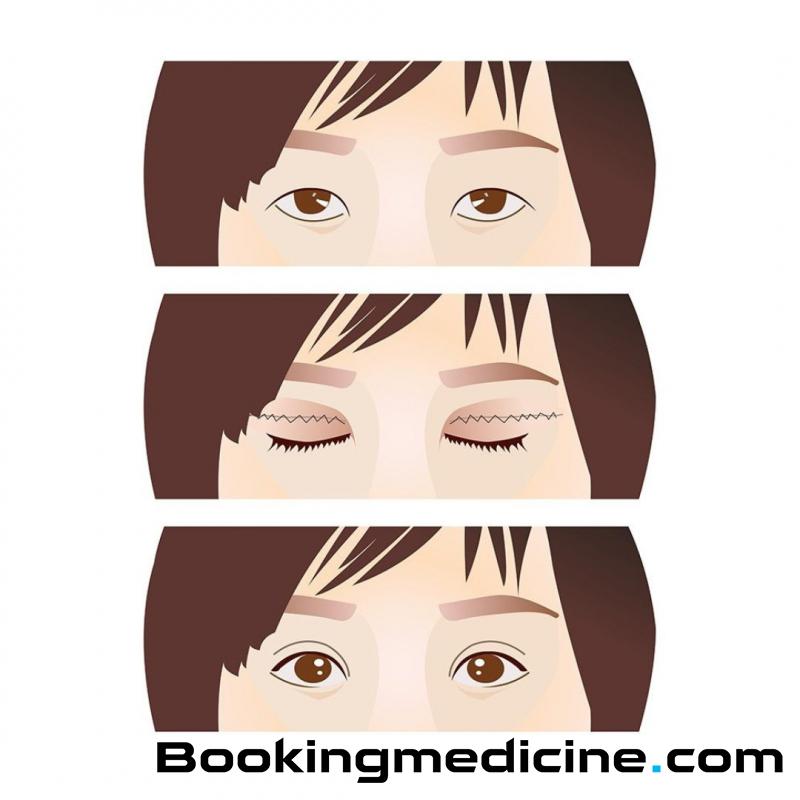 F Clinic - Double eye lids 