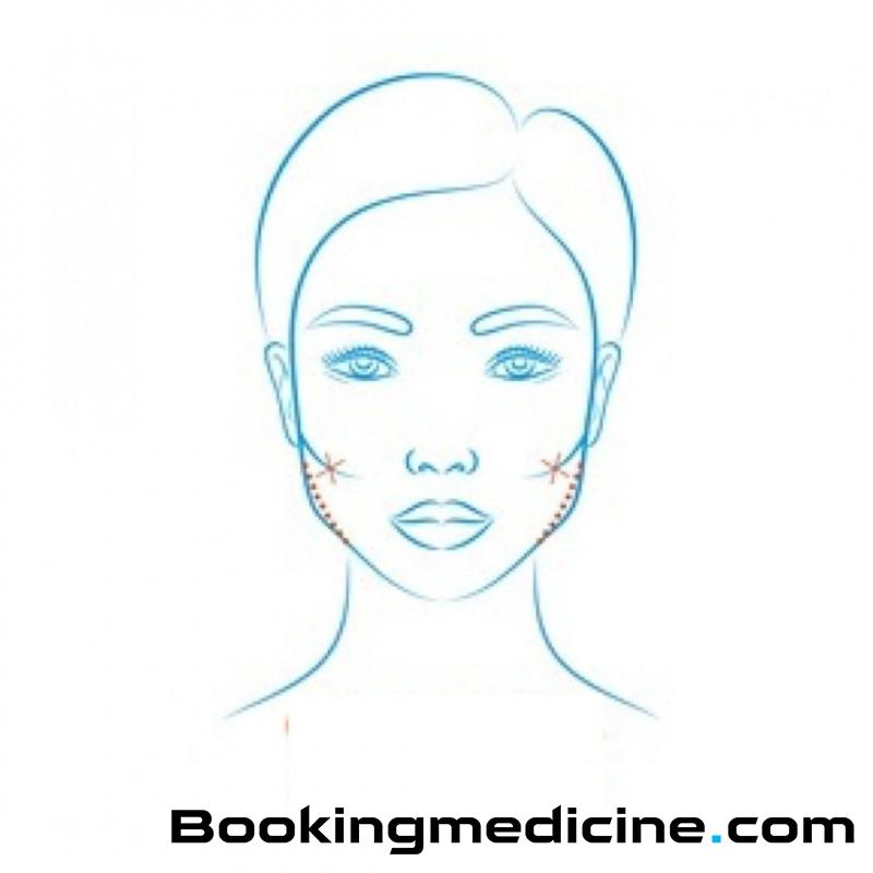 F Clinic - Cheek Bone Reduction 