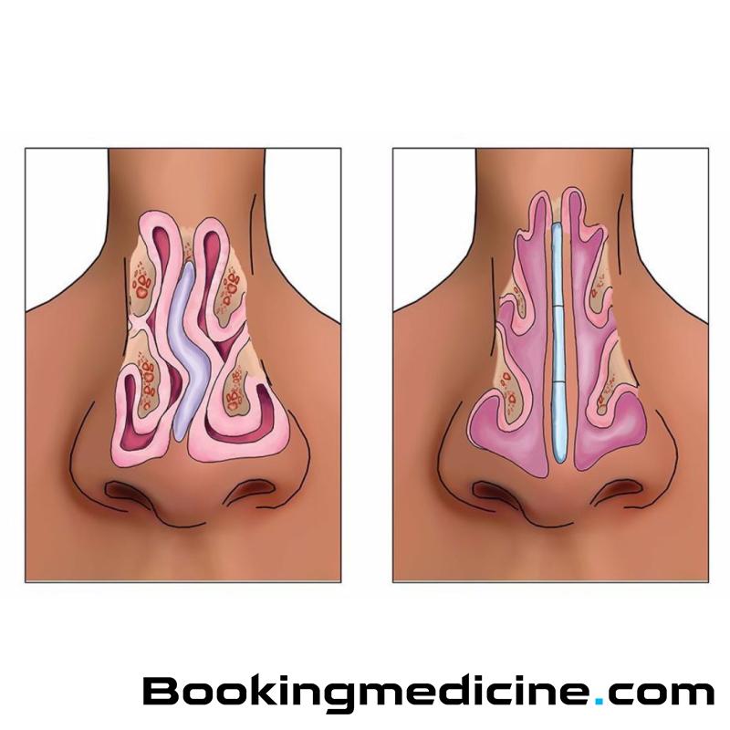 Orea - Septoplasty 