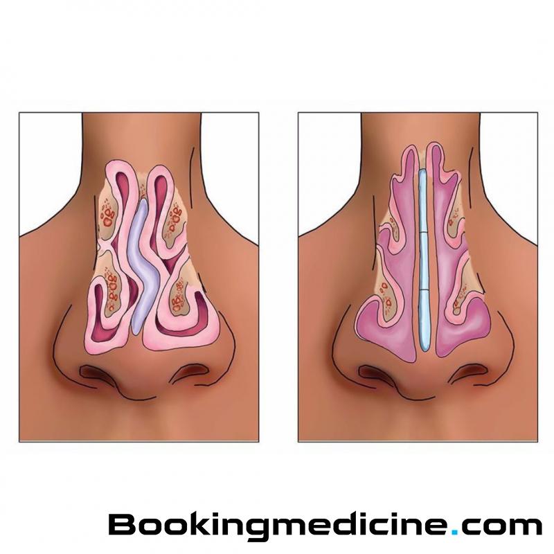 ABClinic Art & Beauty - Septoplasty 