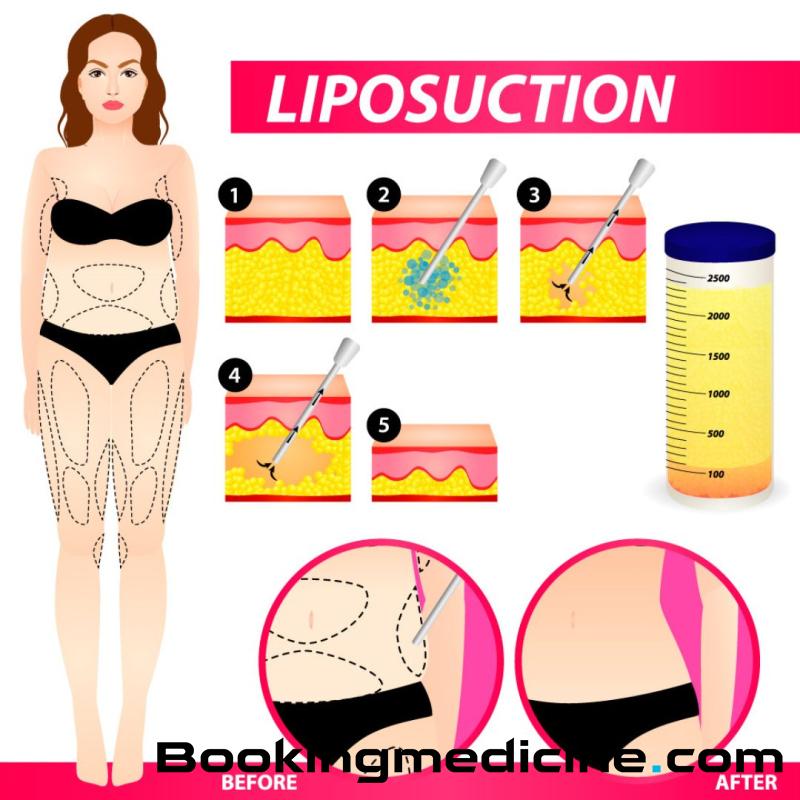 Orea - Vaser Liposuction 