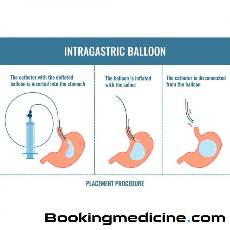 Kucukcekmece Hospital - Intragastric Balloon 