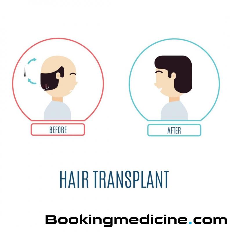 ClinicForYou - Hair Transplant 
