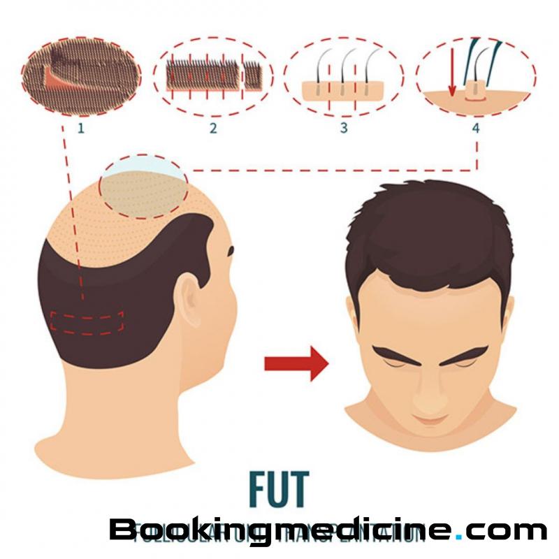 Grow and Glow Clinic - Hair Transplant: Follicular Unit Extraction (FUE) 
