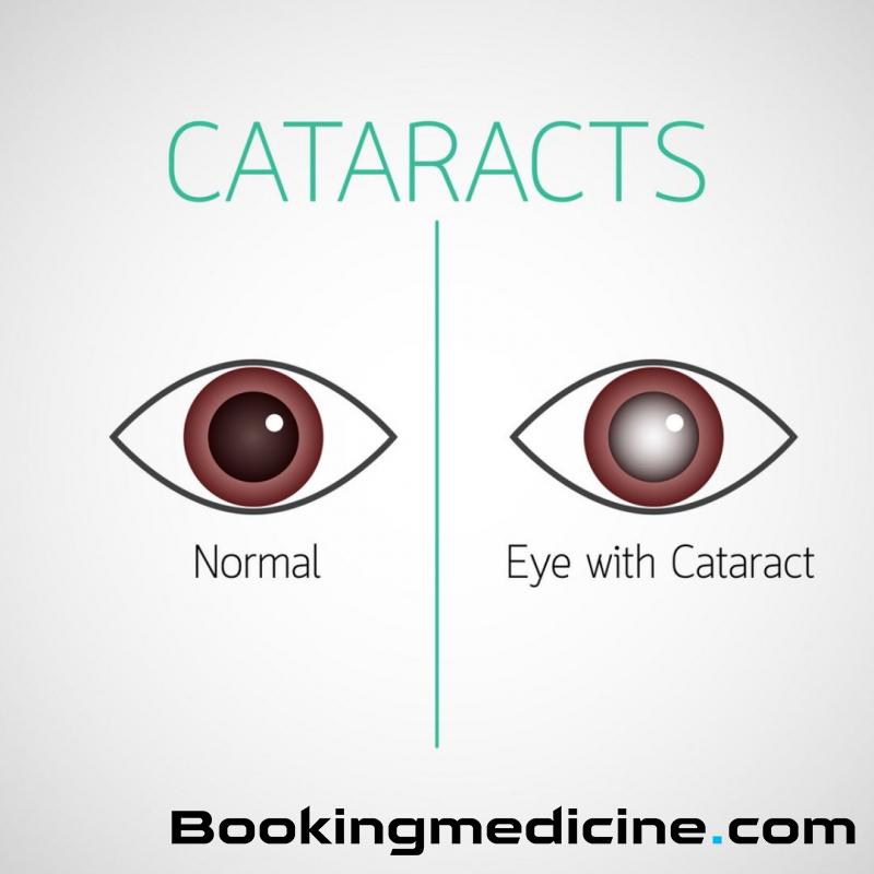 Cerrahi (Surgery Group) - Cataracts 