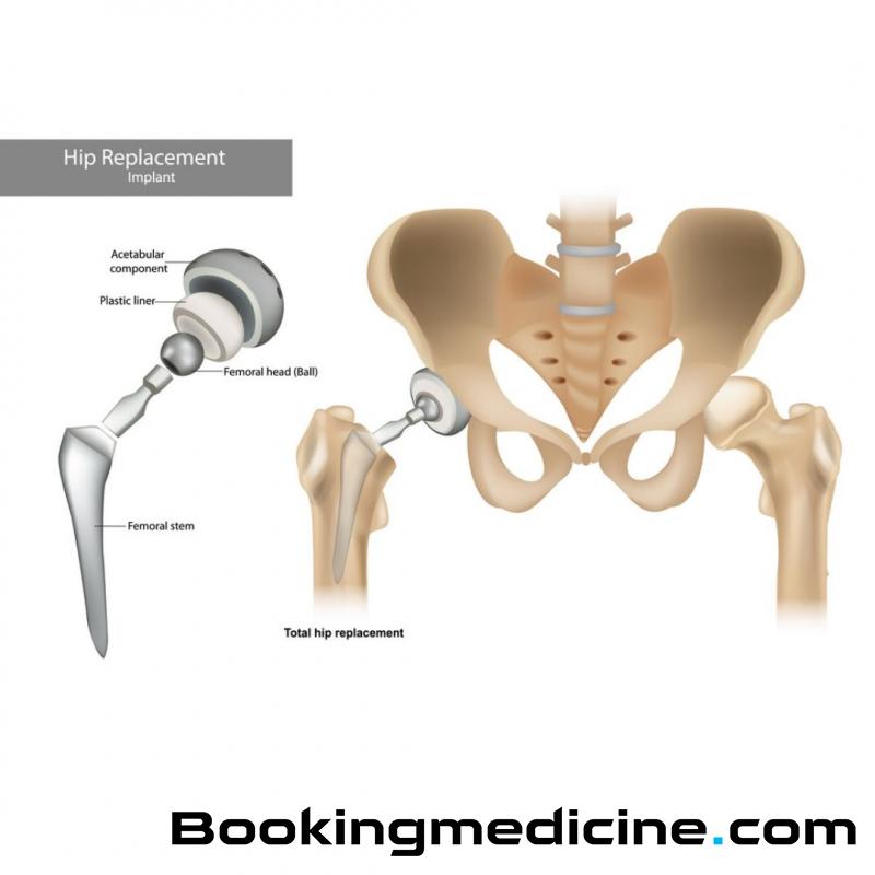 Medipunto Clinic - Hip Replacement 