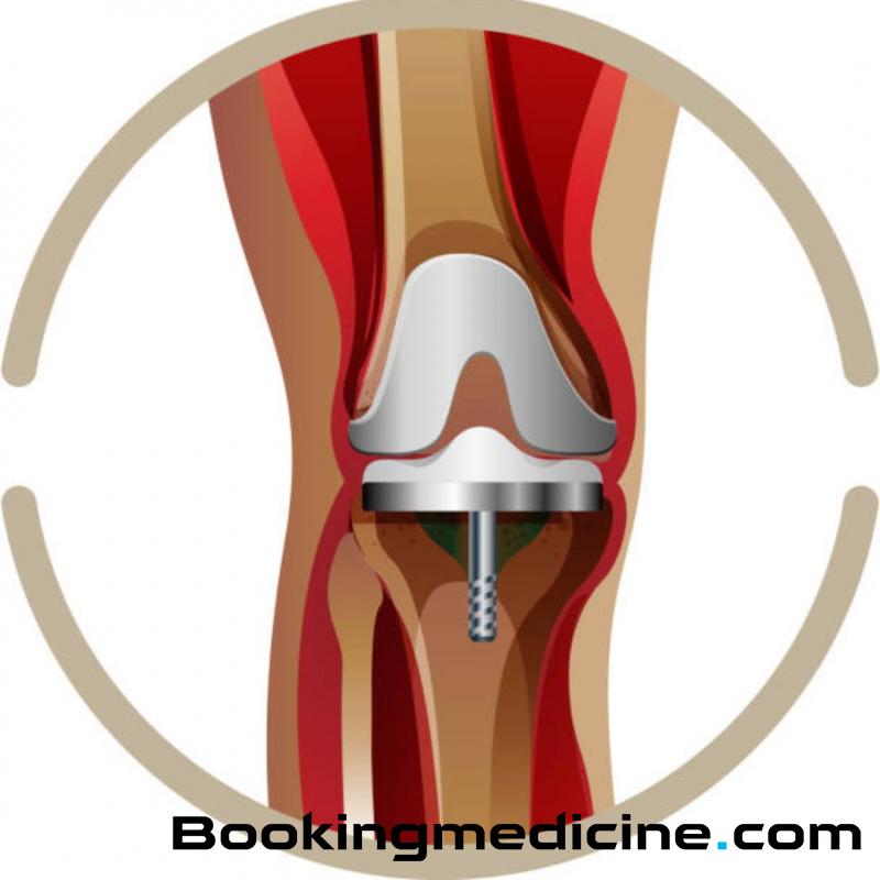 EsteBoss - Knee Replacement 