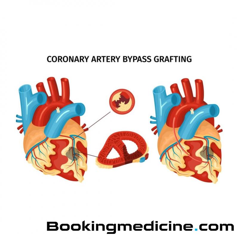 EsteBoss - Coronary Artery Bypass 