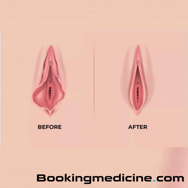Hospital de la Familia - Labiaplasty 