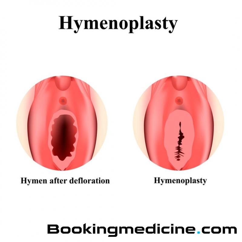 Reyap Hospital - Hymenoplasty 